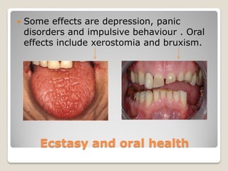    Some effects are depression, panic
    disorders and impulsive behaviour . Oral
    effects include xerostomia and bruxism.




       Ecstasy and oral health
 