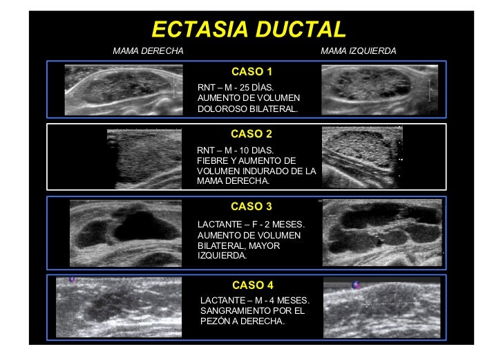 Ectasia Ductal Mamaria del Lactante