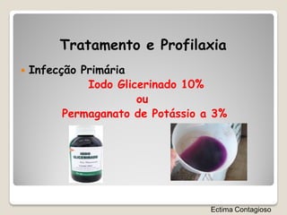 Tratamento e Profilaxia
   Infecção Primária
              Iodo Glicerinado 10%
                       ou
          Permaganato de Potássio a 3%




                                   Ectima Contagioso
 