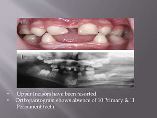 • Upper Incisors have been resorted
• Orthopantogram shows absence of 10 Primary & 11
Permanent teeth
 