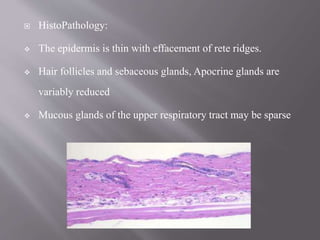  HistoPathology:
 The epidermis is thin with effacement of rete ridges.
 Hair follicles and sebaceous glands, Apocrine glands are
variably reduced
 Mucous glands of the upper respiratory tract may be sparse
 