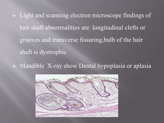  Light and scanning electron microscope findings of
hair shaft abnormalities are longitudinal clefts or
grooves and transverse fissuring,bulb of the hair
shaft is dystrophic
 Mandible X-ray show Dental hypoplasia or aplasia
 
