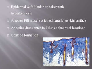  Epidermal & follicular orthokeratotic
hyperkeratosis
 Arrector Pili muscle oriented parallel to skin surface
 Apocrine ducts enter follicles at abnormal locations
 Comedo formation
 