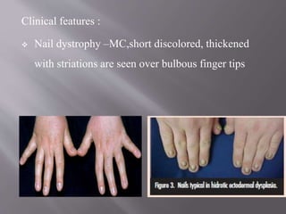 Clinical features :
 Nail dystrophy –MC,short discolored, thickened
with striations are seen over bulbous finger tips
 