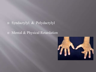  Syndactylyl & Polydactylyl
 Mental & Physical Retardation
 
