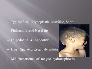  Typical face : Hypoplastic Maxillae, Short
Philtrum, Broad Nasal tip
 Oligodontia & Anodontia
 Hair: Sparse,dry,scalp dermatitis
 MR, hamartoma of tongue, hydronephrosis
 