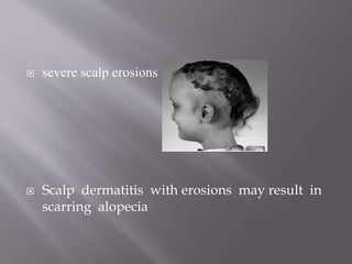  severe scalp erosions
 Scalp dermatitis with erosions may result in
scarring alopecia
 
