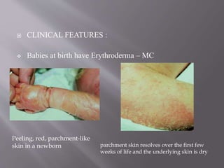  CLINICAL FEATURES :
 Babies at birth have Erythroderma – MC
Peeling, red, parchment-like
skin in a newborn parchment skin resolves over the first few
weeks of life and the underlying skin is dry
 