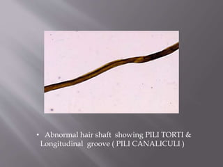 • Abnormal hair shaft showing PILI TORTI &
Longitudinal groove ( PILI CANALICULI )
 