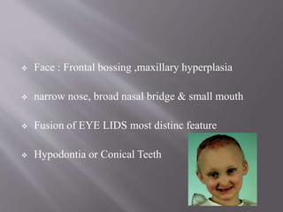  Face : Frontal bossing ,maxillary hyperplasia
 narrow nose, broad nasal bridge & small mouth
 Fusion of EYE LIDS most distinc feature
 Hypodontia or Conical Teeth
 