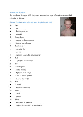 Ectodermal dysplasia
The ectodermal dysplasias (ED) represent a heterogeneous group of conditions characterized
primarily by defective:
Clinical Manifestations of Ectodermal Dysplasia, Gill 2008
1) Skin
 Dry
 Hypopigmentation
 Dermatitis
2) Sweat glands
 Reduced or absent sweating
 Reduced heat tolerance
3) Hair follicles
 Sparse fair hair
 Alopecia
 Eyebrows or eyelashes absent/sparse
4) Nails
 Dystrophic and malformed
5) Face
 Cleft lip/palate
 Frontal bossing
 Depressed nasal bridge
 Class III skeletal pattern
 Reduced face height
6) Eyes
 Cataract
 Defective lacrimation
7) Nose
 Rhinitis
 Epistaxis
8) Dental
 Hypodontia or Anodontia
 Malformed teeth (cone- or peg-shaped)
 