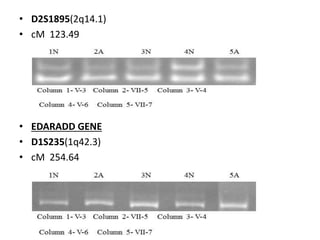 • D2S1895(2q14.1)
• cM 123.49
• EDARADD GENE
• D1S235(1q42.3)
• cM 254.64
 