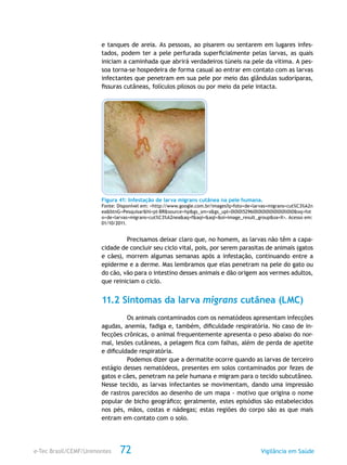 e-Tec Brasil/CEMF/Unimontes Vigilância em Saúde72
e tanques de areia. As pessoas, ao pisarem ou sentarem em lugares infes-
tados, podem ter a pele perfurada superficialmente pelas larvas, as quais
iniciam a caminhada que abrirá verdadeiros túneis na pele da vítima. A pes-
soa torna-se hospedeira de forma casual ao entrar em contato com as larvas
infectantes que penetram em sua pele por meio das glândulas sudoríparas,
fissuras cutâneas, folículos pilosos ou por meio da pele intacta.
Figura 41: Infestação de larva migrans cutânea na pele humana.
Fonte: Disponível em: <http://www.google.com.br/images?q=foto+de+larvas+migrans+cut%C3%A2n
ea&btnG=Pesquisar&hl=pt-BR&source=hp&gs_sm=s&gs_upl=0l0l0l5296l0l0l0l0l0l0l0l0ll0l0&oq=fot
o+de+larvas+migrans+cut%C3%A2nea&aq=f&aqi=&aql=&oi=image_result_group&sa=X>. Acesso em:
01/10/2011.
Precisamos deixar claro que, no homem, as larvas não têm a capa-
cidade de concluir seu ciclo vital, pois, por serem parasitas de animais (gatos
e cães), morrem algumas semanas após a infestação, continuando entre a
epiderme e a derme. Mas lembramos que elas penetram na pele do gato ou
do cão, vão para o intestino desses animais e dão origem aos vermes adultos,
que reiniciam o ciclo.
11.2 Sintomas da larva migrans cutânea (LMC)
Os animais contaminados com os nematódeos apresentam infecções
agudas, anemia, fadiga e, também, dificuldade respiratória. No caso de in-
fecções crônicas, o animal frequentemente apresenta o peso abaixo do nor-
mal, lesões cutâneas, a pelagem fica com falhas, além de perda de apetite
e dificuldade respiratória.
Podemos dizer que a dermatite ocorre quando as larvas de terceiro
estágio desses nematódeos, presentes em solos contaminados por fezes de
gatos e cães, penetram na pele humana e migram para o tecido subcutâneo.
Nesse tecido, as larvas infectantes se movimentam, dando uma impressão
de rastros parecidos ao desenho de um mapa - motivo que origina o nome
popular de bicho geográfico; geralmente, estes episódios são estabelecidos
nos pés, mãos, costas e nádegas; estas regiões do corpo são as que mais
entram em contato com o solo.
 