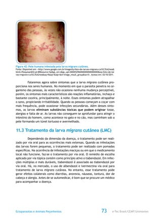e-Tec Brasil/CEMF/UnimontesEctoparasitas e Animais Peçonhentos 73
Figura 42: Pele humana infestada pela larva migrans cutânea.
Fonte: Disponível em: <http://www.google.com.br/images?q=foto+de+larvas+migrans+cut%C3%A2nea&
btnG=Pesquisar&hl=pt-BR&source=hp&gs_sm=s&gs_upl=0l0l0l5296l0l0l0l0l0l0l0l0ll0l0&oq=foto+de+lar
vas+migrans+cut%C3%A2nea&aq=f&aqi=&aql=&oi=image_result_group&sa=X>. Acesso em: 03/10/2011.
Falaremos agora sobre sintomas que a larva migrans cutânea pro-
porciona nos seres humanos. No momento em que o parasita penetra no or-
ganismo das pessoas, às vezes não ocasiona nenhuma mudança perceptível,
porém, os sintomas mais característicos são reações inflamatórias, inchaço e
bastante coceira, principalmente, à noite. Esses sintomas podem atrapalhar
o sono, propiciando irritabilidade. Quando as pessoas começam a coçar com
mais frequência, pode ocasionar infecções secundárias. Além desses sinto-
mas, as larvas eliminam substâncias tóxicas que podem originar tosse,
alergias e falta de ar. As larvas não conseguem se aprofundar para atingir o
intestino do homem, como acontece no gato e no cão, mas caminham sob a
pele formando um túnel tortuoso e avermelhado.
11.3 Tratamento da larva migrans cutânea (LMC)
Dependendo da dimensão da doença, o tratamento pode ser reali-
zado por via oral para as ocorrências mais extensas. Quando as infestações
das larvas forem pequenas, o tratamento pode ser realizado com pomadas
específicas. Na ocorrência de infestações maciças ou em que o medicamento
local não funcione, faz-se o tratamento por via oral. O remédio de escolha
aplicado por via tópica contém como princípio ativo o tiabendazol. Em infec-
ções múltiplas e mais duráveis, tiabendazol é associado ao tiabendazol por
via oral. Há, no mercado, o uso de albendazol e ivermectina via oral para
tratamento de larva migrans cutânea. No entanto, esse tratamento pode
gerar efeitos colaterais como diarréias, anorexia, náuseas, tontura, dor de
cabeça e alergia. Antes de se automedicar, é bom que se procure um médico
para acompanhar a doença.
 