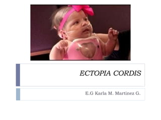 ECTOPIA CORDIS
E.G Karla M. Martinez G.
 