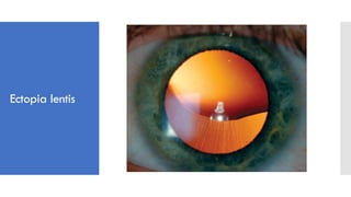 Ectopia lentis classification and management | PPTX