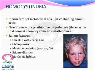 HOMOCYSTINURIA
 Inborn error of metabolism of sulfur containing amino
acids
 Near absence of cystathionine b-synthetase (the enzyme
that converts homocysteine to cystathionine)
 Salient features:
 Fair skin with coarse hair
 Osteoporosis
 Mental retardation (nearly 50%)
 Seizure disorder
 Marfanoid habitus
 