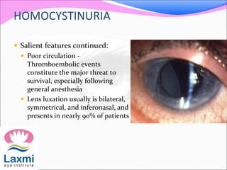 HOMOCYSTINURIA
 Salient features continued:
 Poor circulation -
Thromboembolic events
constitute the major threat to
survival, especially following
general anesthesia
 Lens luxation usually is bilateral,
symmetrical, and inferonasal, and
presents in nearly 90% of patients
 