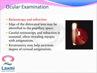 Ocular Examination
 Retinoscopy and refraction
 Edge of the dislocated lens may be
identified in the pupillary space.
 Careful retinoscopy and refraction is
essential, often revealing myopia
with astigmatism.
 Keratometry may help ascertain
degree of corneal astigmatism.
 