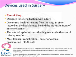 Devices used in Surgery
 Cionni Ring
 Designed for scleral fixation with suture
 One or two hooks extending from the ring, an eyelet
located on the hook located behind the iris just in front of
anterior capsule
 The sutured eyelet anchors the ring to sclera in the area of
missing zonules
 Most frequent complication - posterior capsule
opacification (PCO) -20%
Vasavada AR, Praveen MR, Vasavada VA, Yeh RY, Srivastava S, Koul A, Trivedi RH. Cionni ring and in-the-bag
intraocular lens implantation for subluxated lenses: a prospective case series. Am J Ophthalmol. 2012
Jun;153(6):1144-53.
Irit Bahar, Igor Kaiserman, David Rootman. Cionni endocapsular ring implantation in Marfan's Syndrome. Br J
Ophthalmol. 2007 November; 91(11): 1477–1480.
 
