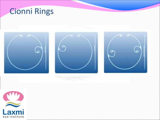 Cionni Rings
 