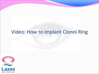 Video: How to implant Cionni Ring
 