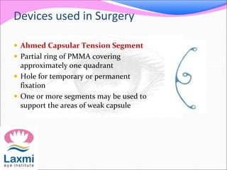  Ahmed Capsular Tension Segment
 Partial ring of PMMA covering
approximately one quadrant
 Hole for temporary or permanent
fixation
 One or more segments may be used to
support the areas of weak capsule
Devices used in Surgery
 