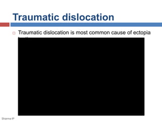 Traumatic dislocation 
 Traumatic dislocation is most common cause of ectopia 
lentis. 
Sharma IP 
 