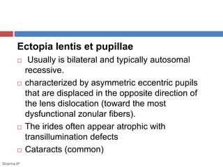 Ectopia lentis et pupillae 
 Usually is bilateral and typically autosomal 
recessive. 
 characterized by asymmetric eccentric pupils 
that are displaced in the opposite direction of 
the lens dislocation (toward the most 
dysfunctional zonular fibers). 
 The irides often appear atrophic with 
transillumination defects 
 Cataracts (common) 
Sharma IP 
 