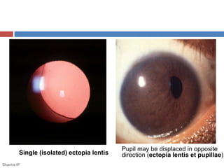 Pupil may be displaced in opposite 
Single (isolated) ectopia lentis direction (ectopia lentis et pupillae) 
Sharma IP 
 