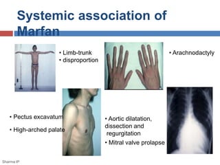 Systemic association of 
Marfan 
• Limb-trunk 
• disproportion 
• Arachnodactyly 
• Pectus excavatum 
• High-arched palate 
• Aortic dilatation, 
dissection and 
regurgitation 
• Mitral valve prolapse 
Sharma IP 
 