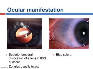 Ocular manifestation 
 Superio-temporal 
dislocation of a lens in 80% 
of cases 
 Zonules usually intact 
 Blue sclera 
Sharma IP 
 