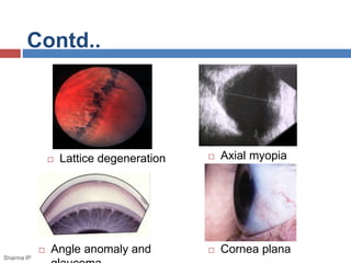 Contd.. 
 Axial myopia  Lattice degeneration 
 Cornea plana 
 Angle anomaly and 
glaucoma 
Sharma IP 
 