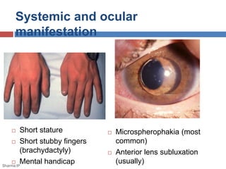 Systemic and ocular 
manifestation 
 Short stature 
 Short stubby fingers 
(brachydactyly) 
 Mental handicap 
 Microspherophakia (most 
common) 
 Anterior lens subluxation 
(usually) 
Sharma IP 
 