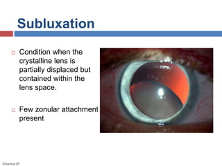 Subluxation 
 Condition when the 
crystalline lens is 
partially displaced but 
contained within the 
lens space. 
 Few zonular attachment 
present 
Sharma IP 
 