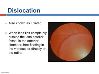 Dislocation 
 Also known as luxated 
 When lens lies completely 
outside the lens patellar 
fossa, in the anterior 
chamber, free-floating in 
the vitreous, or directly on 
the retina. 
Sharma IP 
 