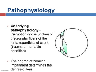 Pathophysiology 
 Underlying 
pathophysiology - 
Disruption or dysfunction of 
the zonular fibers of the 
lens, regardless of cause 
(trauma or heritable 
condition) 
 The degree of zonular 
impairment determines the 
degree of lens 
Sharma IP 
 