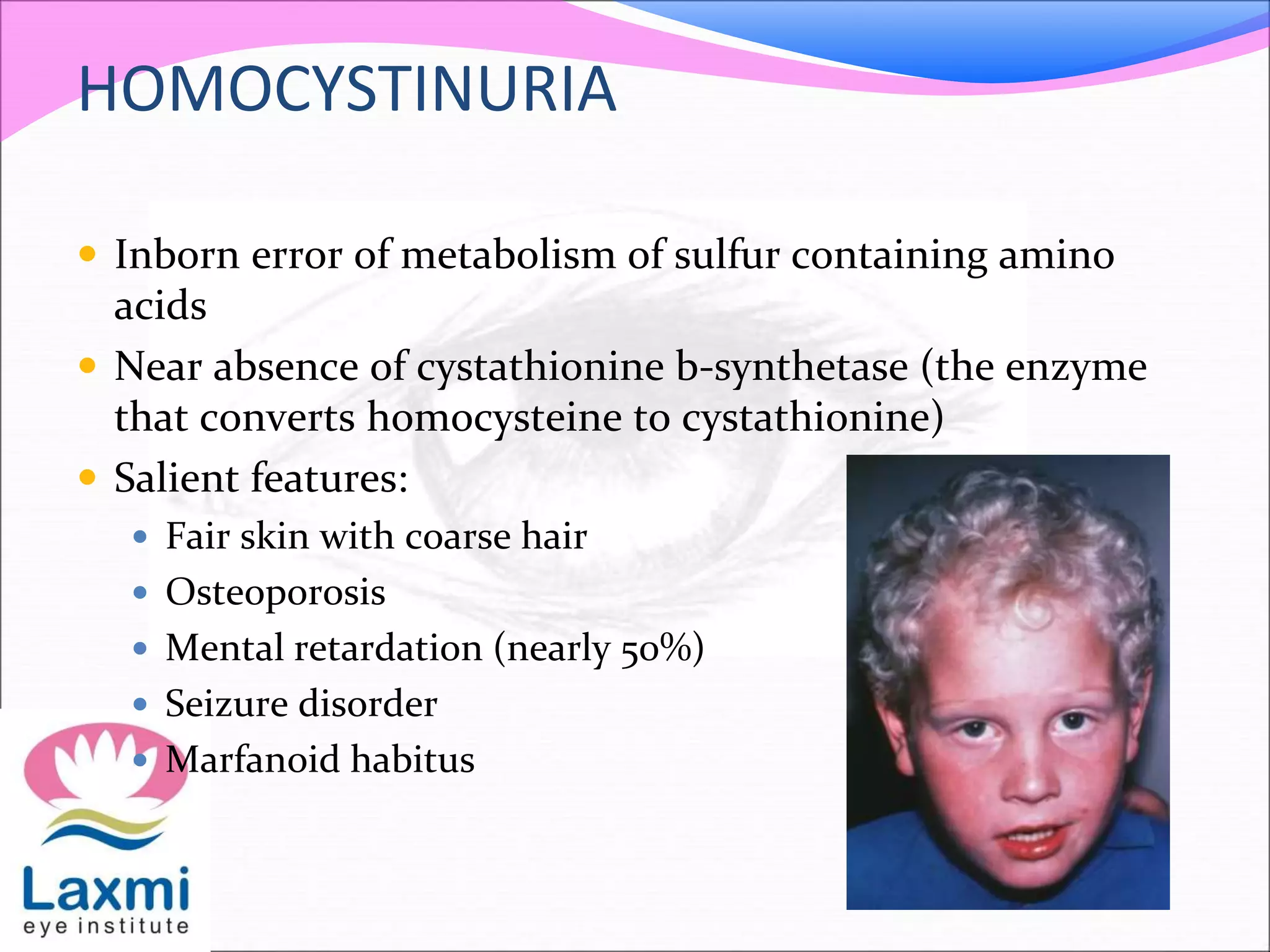 HOMOCYSTINURIA
 Inborn error of metabolism of sulfur containing amino
acids
 Near absence of cystathionine b-synthetase (the enzyme
that converts homocysteine to cystathionine)
 Salient features:
 Fair skin with coarse hair
 Osteoporosis
 Mental retardation (nearly 50%)
 Seizure disorder
 Marfanoid habitus
 