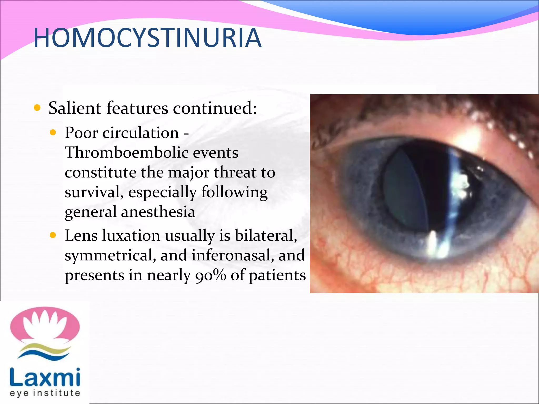 HOMOCYSTINURIA
 Salient features continued:
 Poor circulation -
Thromboembolic events
constitute the major threat to
survival, especially following
general anesthesia
 Lens luxation usually is bilateral,
symmetrical, and inferonasal, and
presents in nearly 90% of patients
 