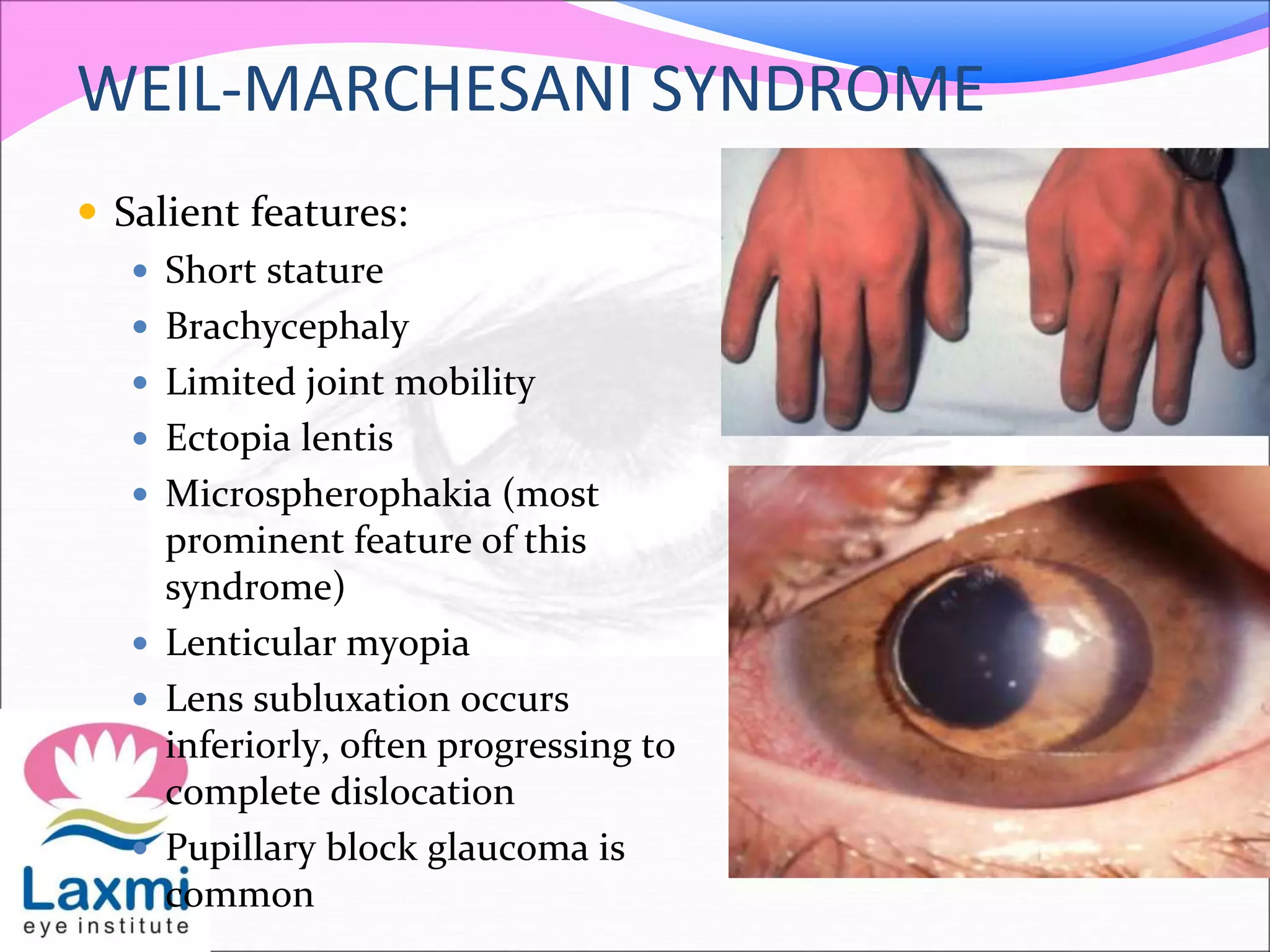 WEIL-MARCHESANI SYNDROME
 Salient features:
 Short stature
 Brachycephaly
 Limited joint mobility
 Ectopia lentis
 Microspherophakia (most
prominent feature of this
syndrome)
 Lenticular myopia
 Lens subluxation occurs
inferiorly, often progressing to
complete dislocation
 Pupillary block glaucoma is
common
 