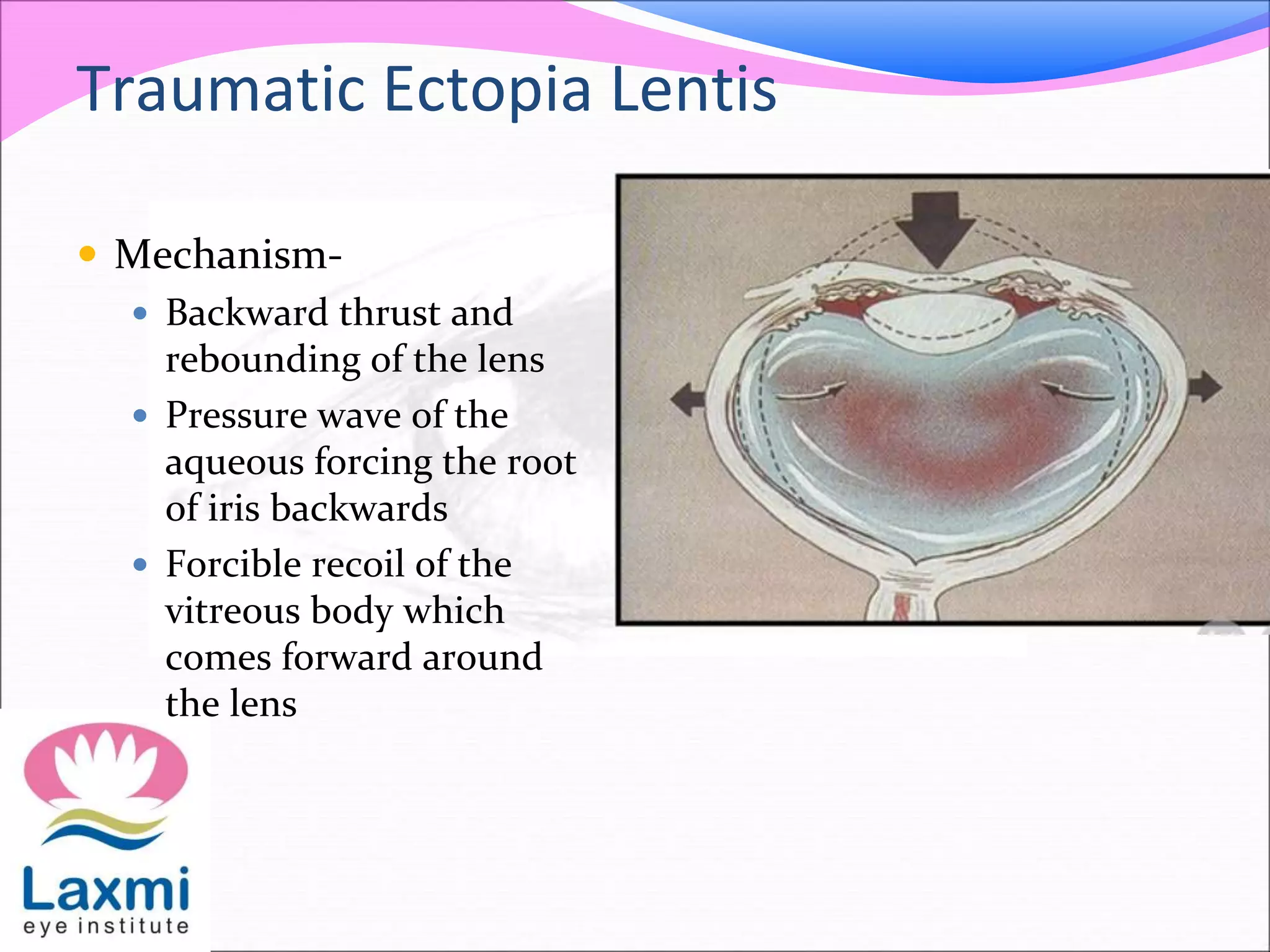 Traumatic Ectopia Lentis
 Mechanism-
 Backward thrust and
rebounding of the lens
 Pressure wave of the
aqueous forcing the root
of iris backwards
 Forcible recoil of the
vitreous body which
comes forward around
the lens
 