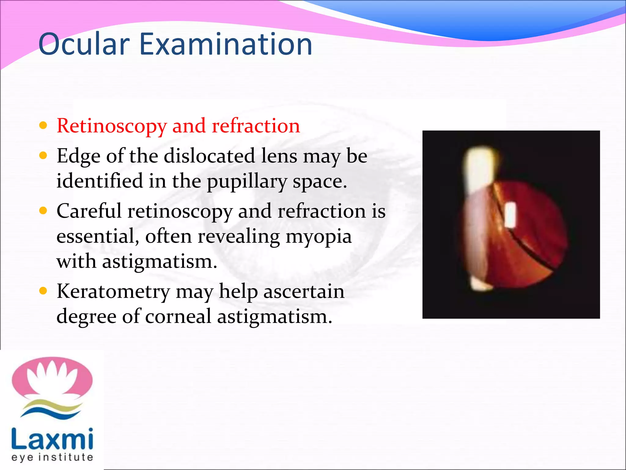 Ocular Examination
 Retinoscopy and refraction
 Edge of the dislocated lens may be
identified in the pupillary space.
 Careful retinoscopy and refraction is
essential, often revealing myopia
with astigmatism.
 Keratometry may help ascertain
degree of corneal astigmatism.
 