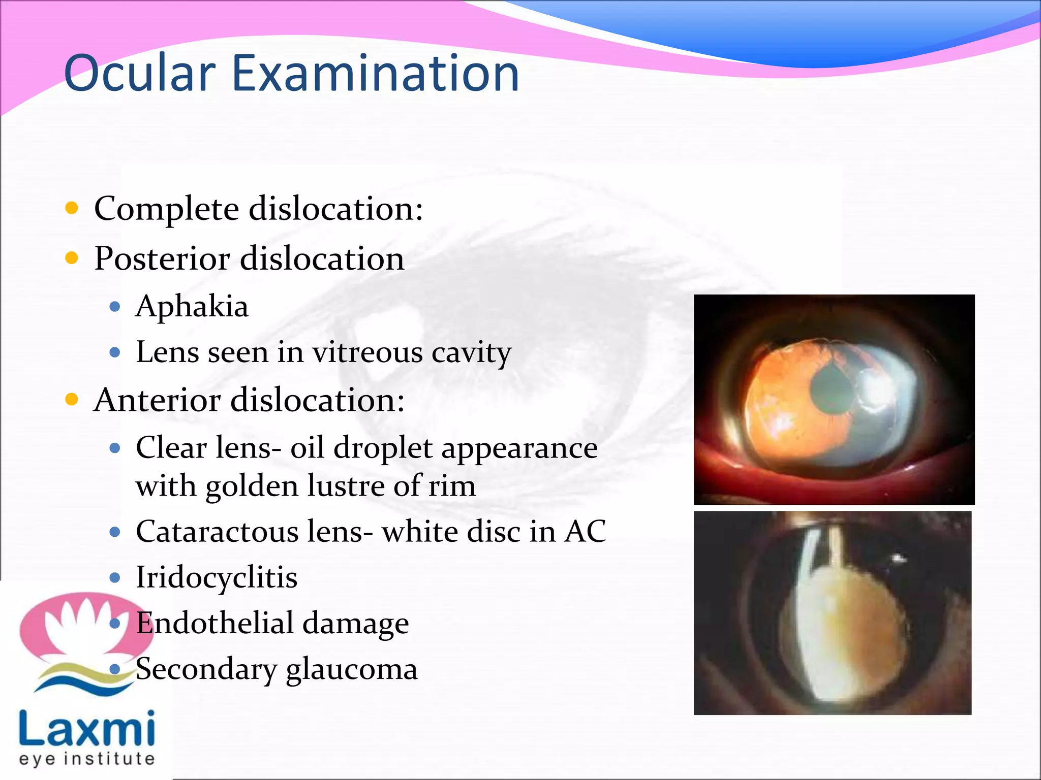 Ocular Examination
 Complete dislocation:
 Posterior dislocation
 Aphakia
 Lens seen in vitreous cavity
 Anterior dislocation:
 Clear lens- oil droplet appearance
with golden lustre of rim
 Cataractous lens- white disc in AC
 Iridocyclitis
 Endothelial damage
 Secondary glaucoma
 