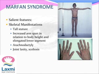 MARFAN SYNDROME
 Salient features:
 Skeletal Manifestations
 Tall stature
 Increased arm span in
relation to body height and
elongated lower segment
 Arachnodactyly
 Joint laxity, scoliosis
 