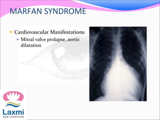 MARFAN SYNDROME
 Cardiovascular Manifestations
 Mitral valve prolapse, aortic
dilatation
 