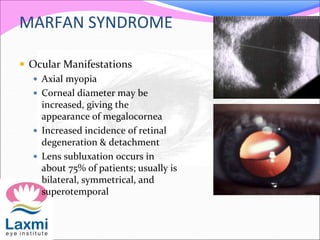 MARFAN SYNDROME
 Ocular Manifestations
 Axial myopia
 Corneal diameter may be
increased, giving the
appearance of megalocornea
 Increased incidence of retinal
degeneration & detachment
 Lens subluxation occurs in
about 75% of patients; usually is
bilateral, symmetrical, and
superotemporal
 