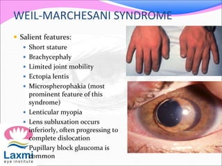 WEIL-MARCHESANI SYNDROME
 Salient features:
 Short stature
 Brachycephaly
 Limited joint mobility
 Ectopia lentis
 Microspherophakia (most
prominent feature of this
syndrome)
 Lenticular myopia
 Lens subluxation occurs
inferiorly, often progressing to
complete dislocation
 Pupillary block glaucoma is
common
 