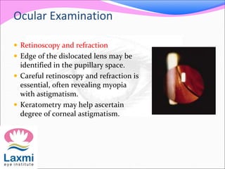 Ocular Examination
 Retinoscopy and refraction
 Edge of the dislocated lens may be
identified in the pupillary space.
 Careful retinoscopy and refraction is
essential, often revealing myopia
with astigmatism.
 Keratometry may help ascertain
degree of corneal astigmatism.
 