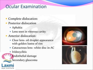 Ocular Examination
 Complete dislocation:
 Posterior dislocation
 Aphakia
 Lens seen in vitreous cavity
 Anterior dislocation:
 Clear lens- oil droplet appearance
with golden lustre of rim
 Cataractous lens- white disc in AC
 Iridocyclitis
 Endothelial damage
 Secondary glaucoma
 