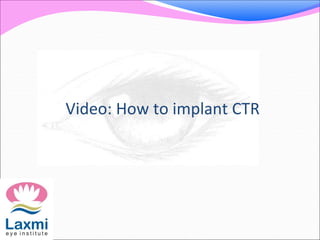 Video: How to implant CTR
 